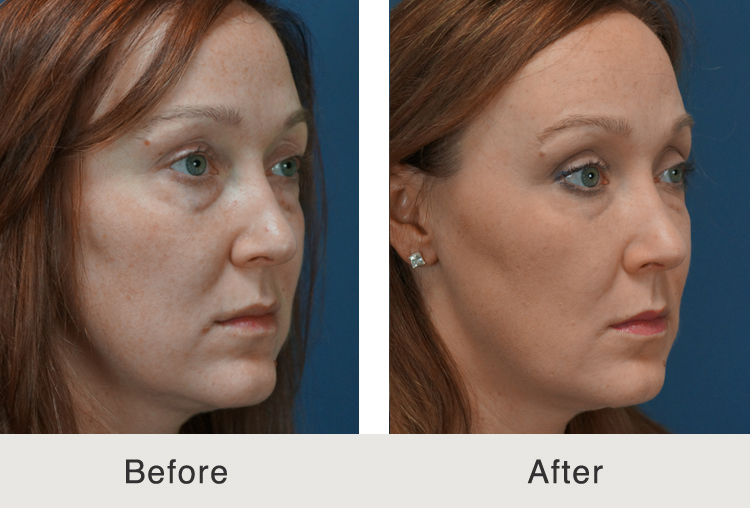 Liquid Facelift
