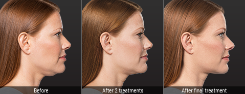 Kybell Treatments