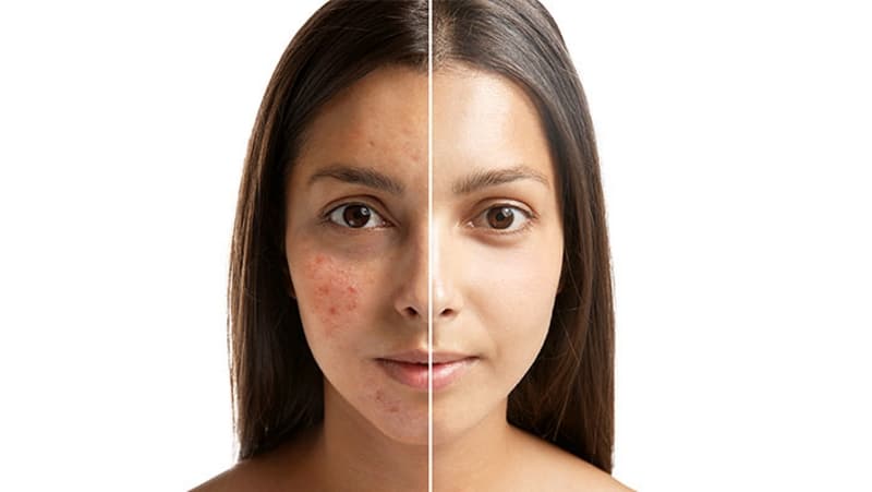 acne treatment mission valley san diego