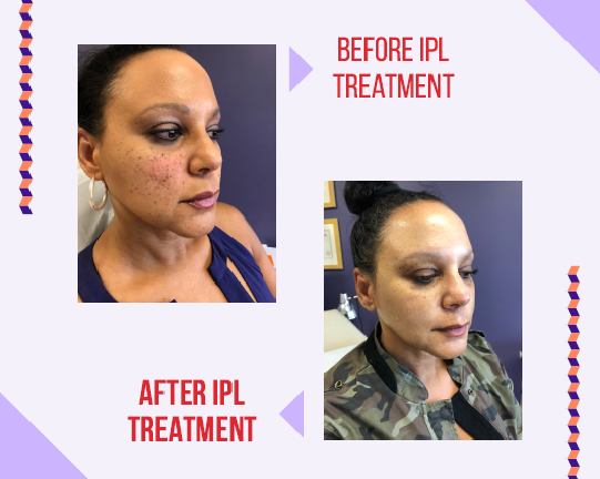 IPL Treatment