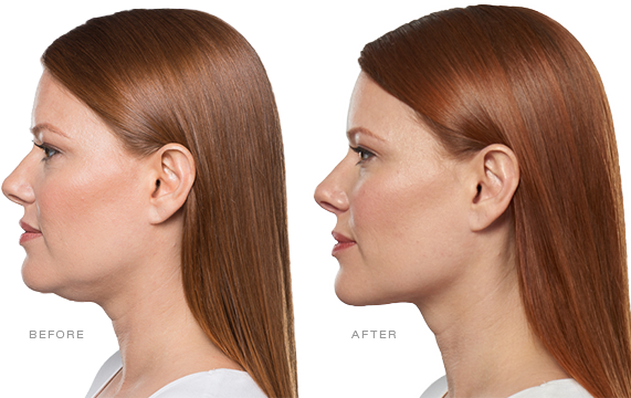 AboutKybella