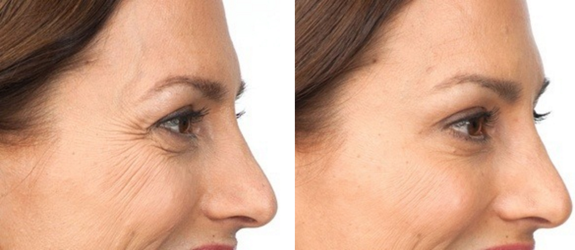 Botox Mission Valley