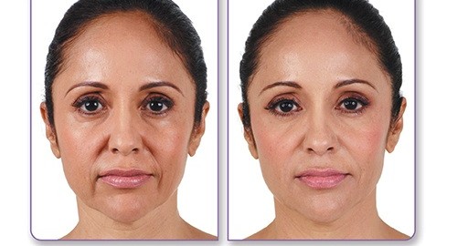 Fillers Mission Valley