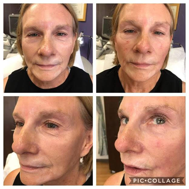 Fillers San Diego